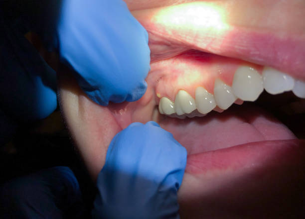 Best Emergency Dental Care for Broken or Chipped Teeth in Whitesboro, TX